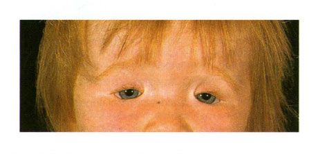 Two-sided coloboma of the eyelids in a child with Golden's syndrome.  Closure of the eye slit on the left
