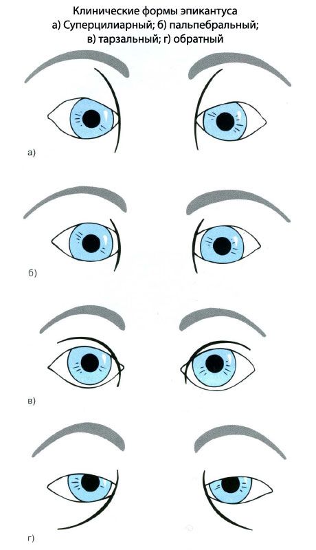 Clinical forms of epicanthus.  a) Superciliary, b) palpebral, c) tarsal, d) reverse