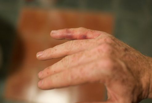 Pain in the joints of the hands