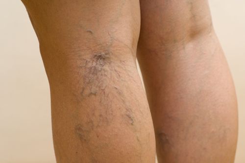 How to cope with deep vein thrombosis