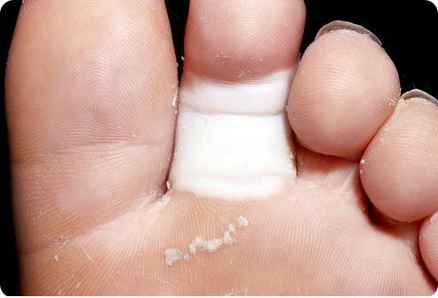 Causes of Fracture of Toes