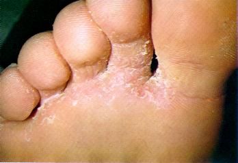 this disease is also called an athlete's foot
