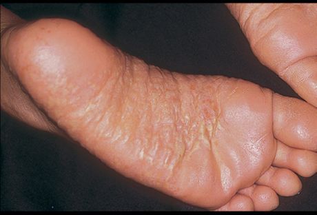 Dermatitis of legs and its causes