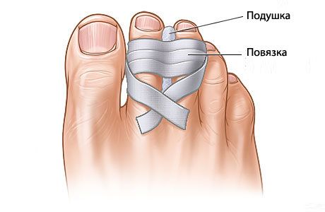 What are the prospects for restoring broken toes?