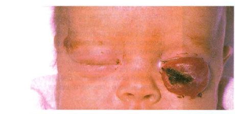 Hemangioma of the lower eyelid. 