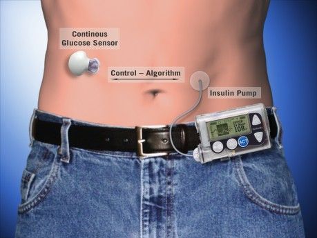 diabetes artificial pancreas