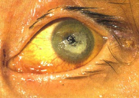 Bilateral keratitis caused by Candida in a child with severe immunodeficiency