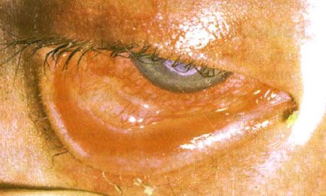 Syndrome Stevens-Johnson.  Two-sided desquamative conjunctivitis with areas of necrosis.  Heavy keratitis, which caused the appearance of scars on the cornea.  The situation was complicated by the addition of the syndrome of "dry" eyes