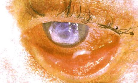 Syndrome Stevens-Johnson.  Two-sided desquamative conjunctivitis with areas of necrosis.  Heavy keratitis, which caused the appearance of scars on the cornea.  The situation was complicated by the addition of the syndrome of "dry" eyes