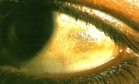 Xerophthalmus.  Bito's plaques look elevated, with the deposition of multiple scales, conjunctiva sites located in a zone not covered by eyelids.  As in this case, pathological areas are often pigmented.