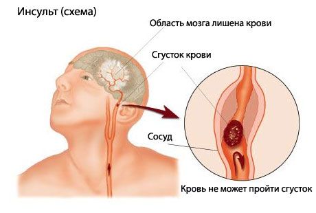 An easy test predicts a fatal stroke