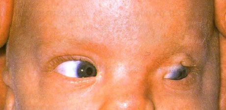 Fraser Syndrome.  Incomplete cryptophthalmos of the left eye.