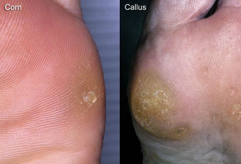 Hemorrhages and calluses