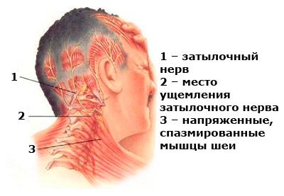 Occipital pain