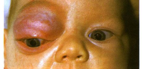 Capillary hemangioma of the anterior part of the orbit and upper eyelid.  Neoplasm tends to progress