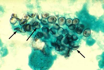 The causative agent of pneumocystis (Pneumocystis jiroveci)