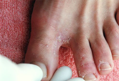Epidermophytia of foot