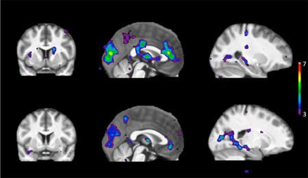 Scanning shows areas of brain activity in response to stimuli in people with a fast metabolism of nicotine (upper row) and a slow metabolism of nicotine (lower row)