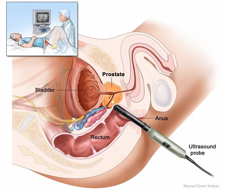 An effective drug against prostate cancer based on tea and gold has been created