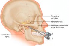 Triangular Nerve Block Patch Trigeminal nerve block: when it helps, how it's performed, and what are ...