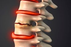 Intervertebral Disc Degeneration: Causes, Symptoms, Diagnosis ...