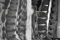 Discitis: Causes, Symptoms, Diagnosis, and Treatment | Health Facts ...