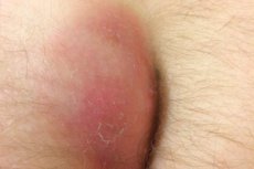 Pilonidal abscess: symptoms, diagnosis, treatment, and prognosis ...