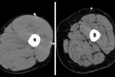 Sarkopenia: causes, symptoms, diagnosis, treatment ...