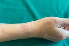 Sheathing Injury Tenosynovitis: Causes, Symptoms, Diagnosis, Treatment, and Prognosis ...