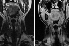 Thyroid MRI: Indications, Possibilities, Limitations, and ...