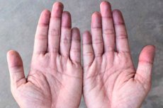 Blue Fingers and Toes: Causes, Diagnosis, and Treatment | Health Facts ...