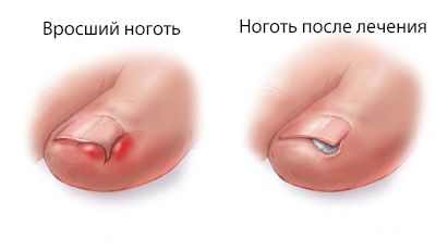Removal of ingrown nail