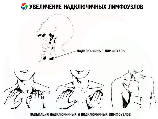 left supraclavicular lymph node swollen sign