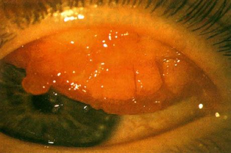 Giant papilla with severe spring conjunctivitis