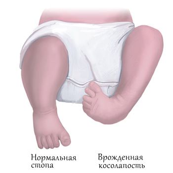 Treatment of clubfoot without surgery
